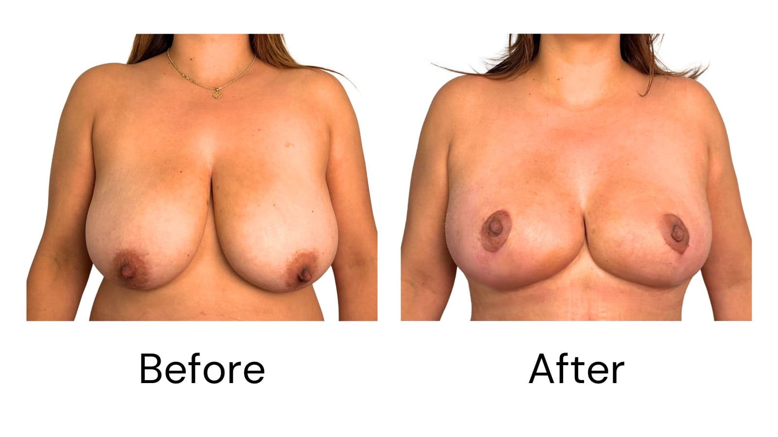 Breast Reduction