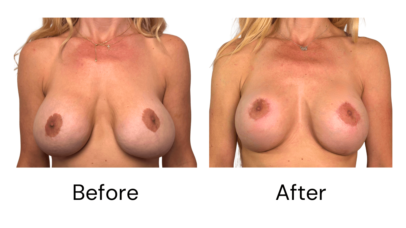 Breast Lift