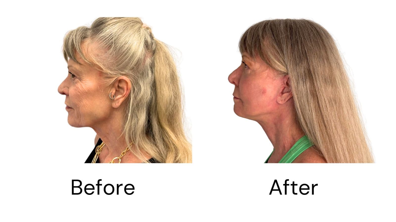 Neck Lift
