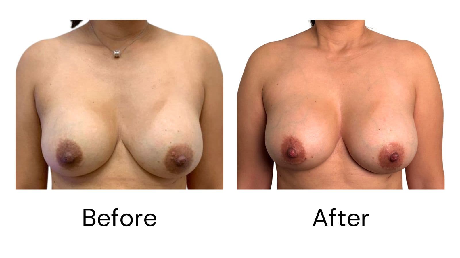 Breast Revision