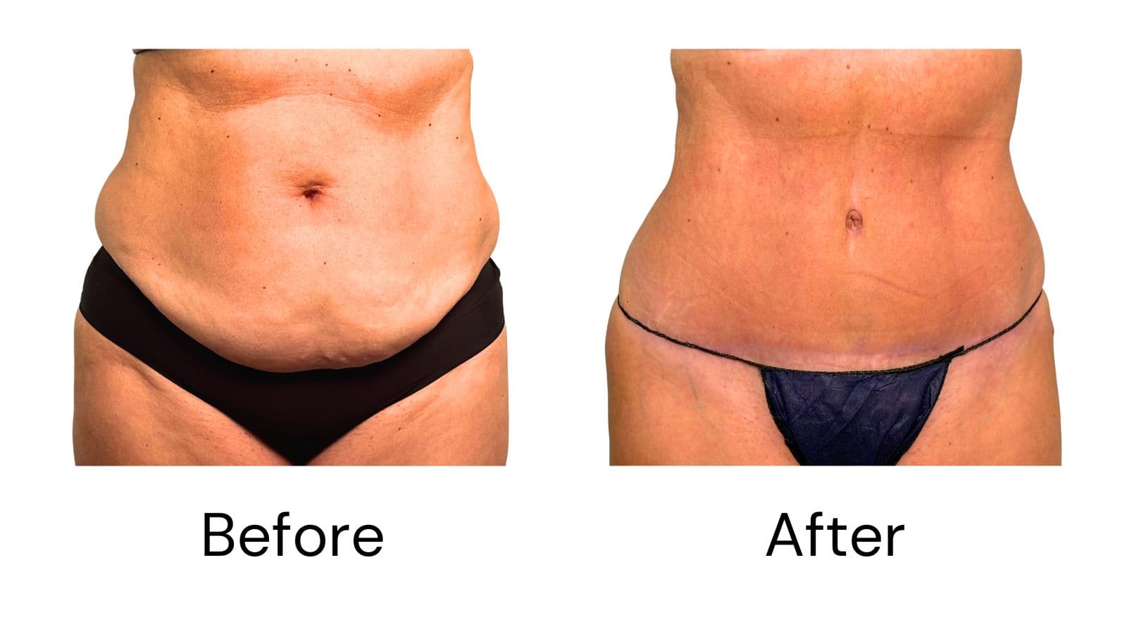 Tummy Tuck