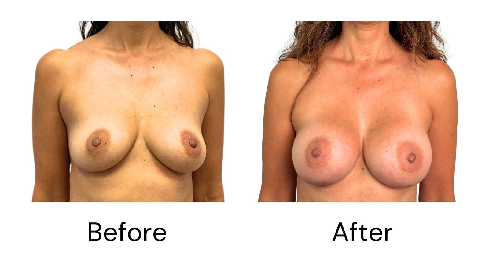 Breast Augmentation