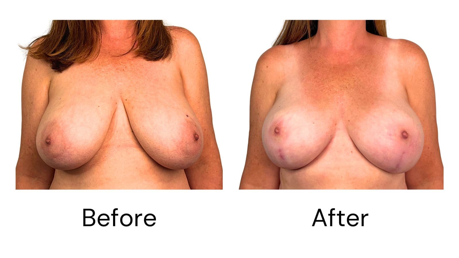 Breast Lift