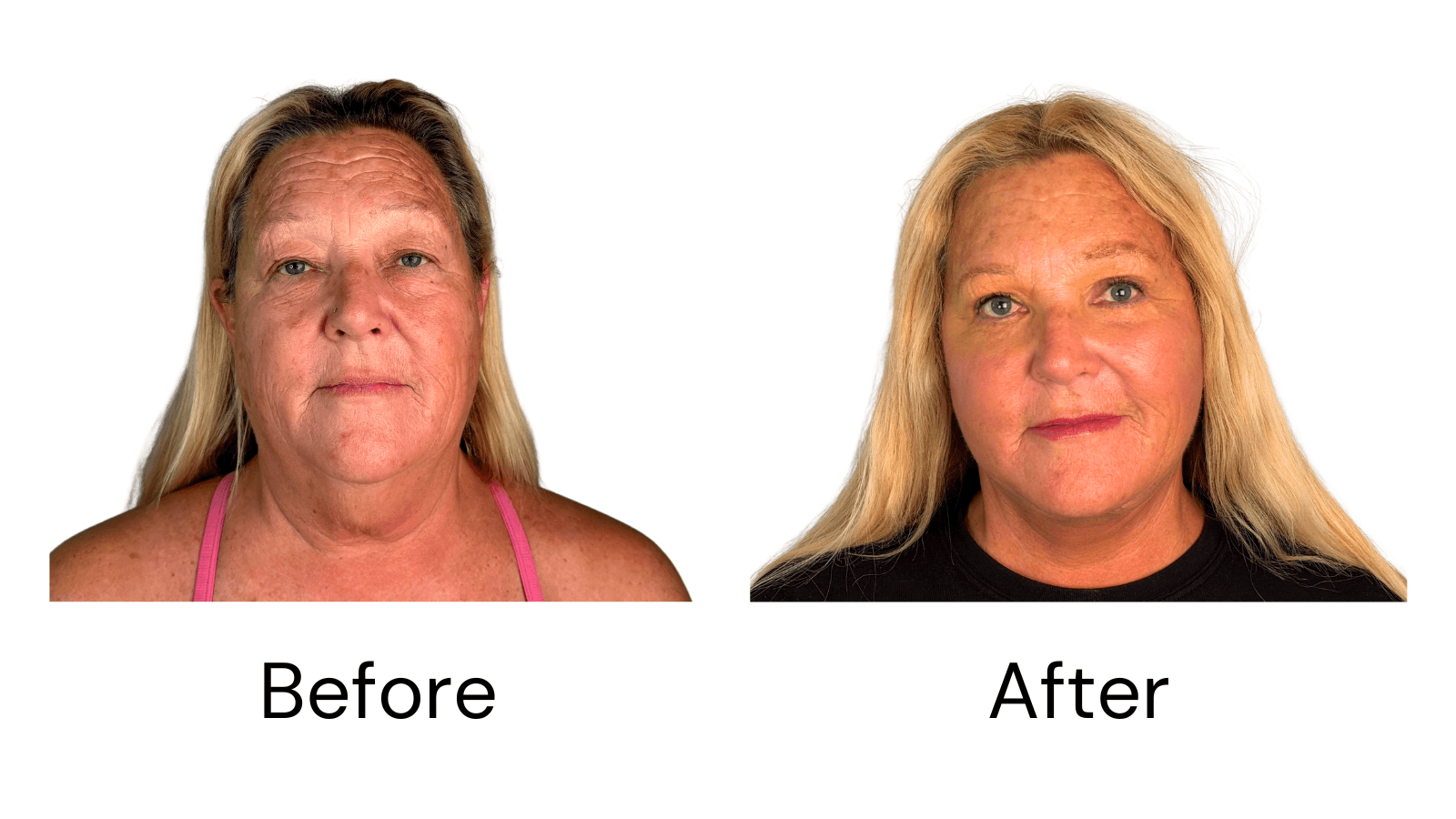 Facelift
