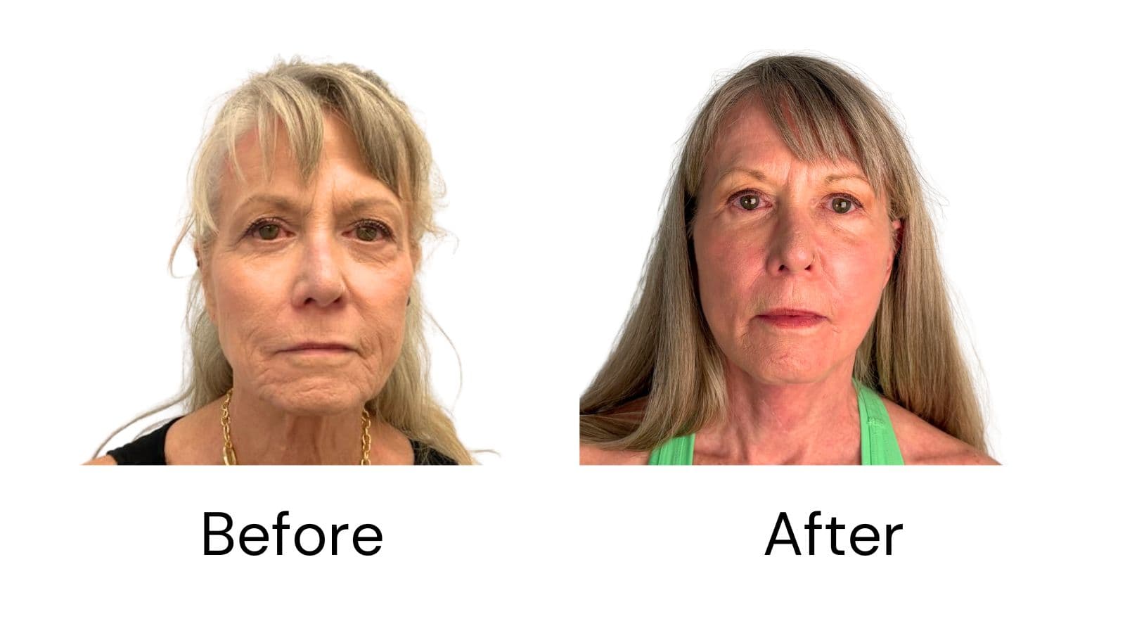 Facelift