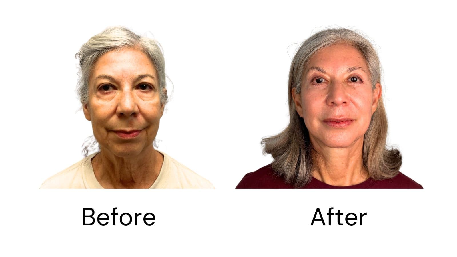 Facelift