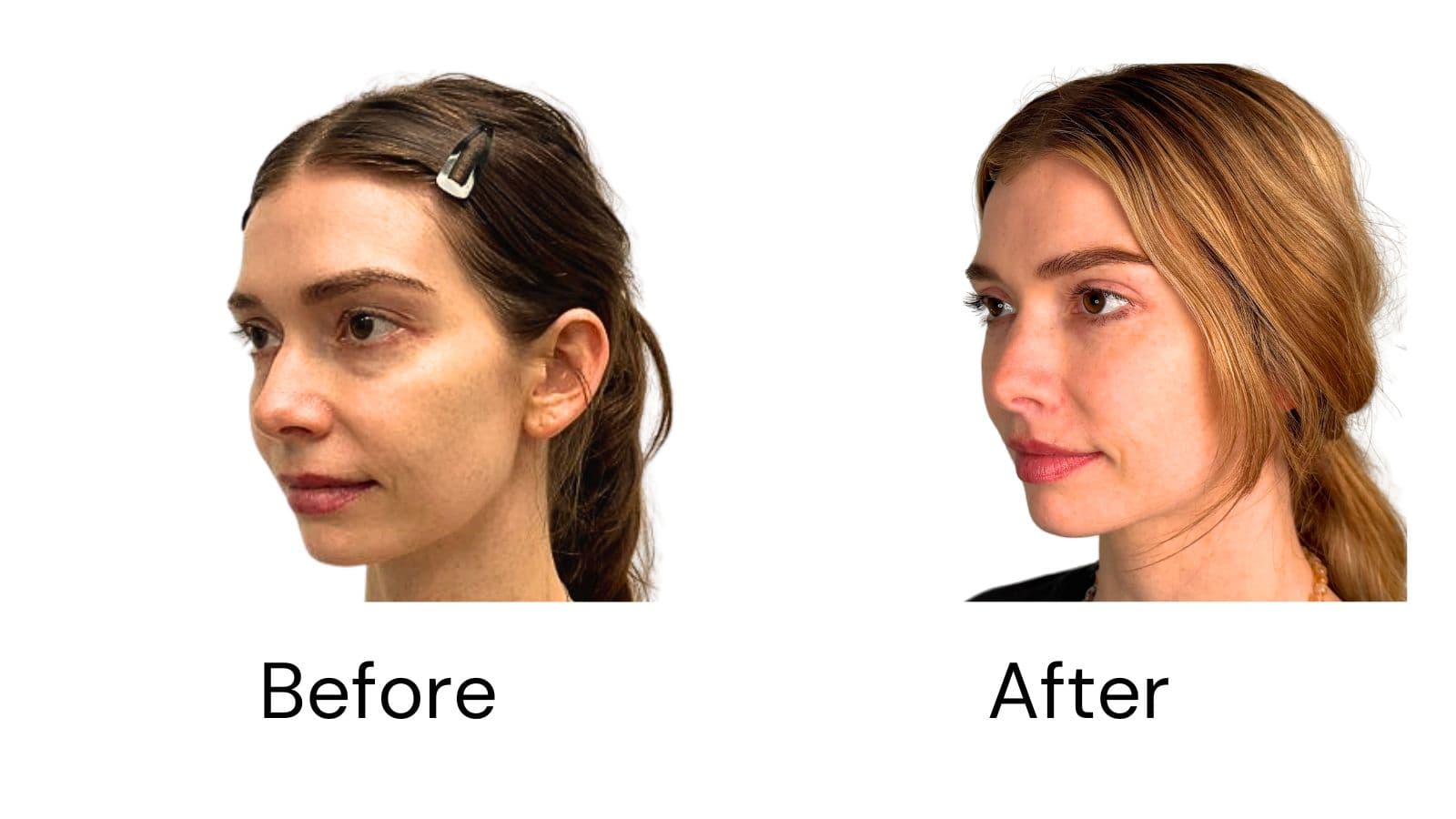 Facelift