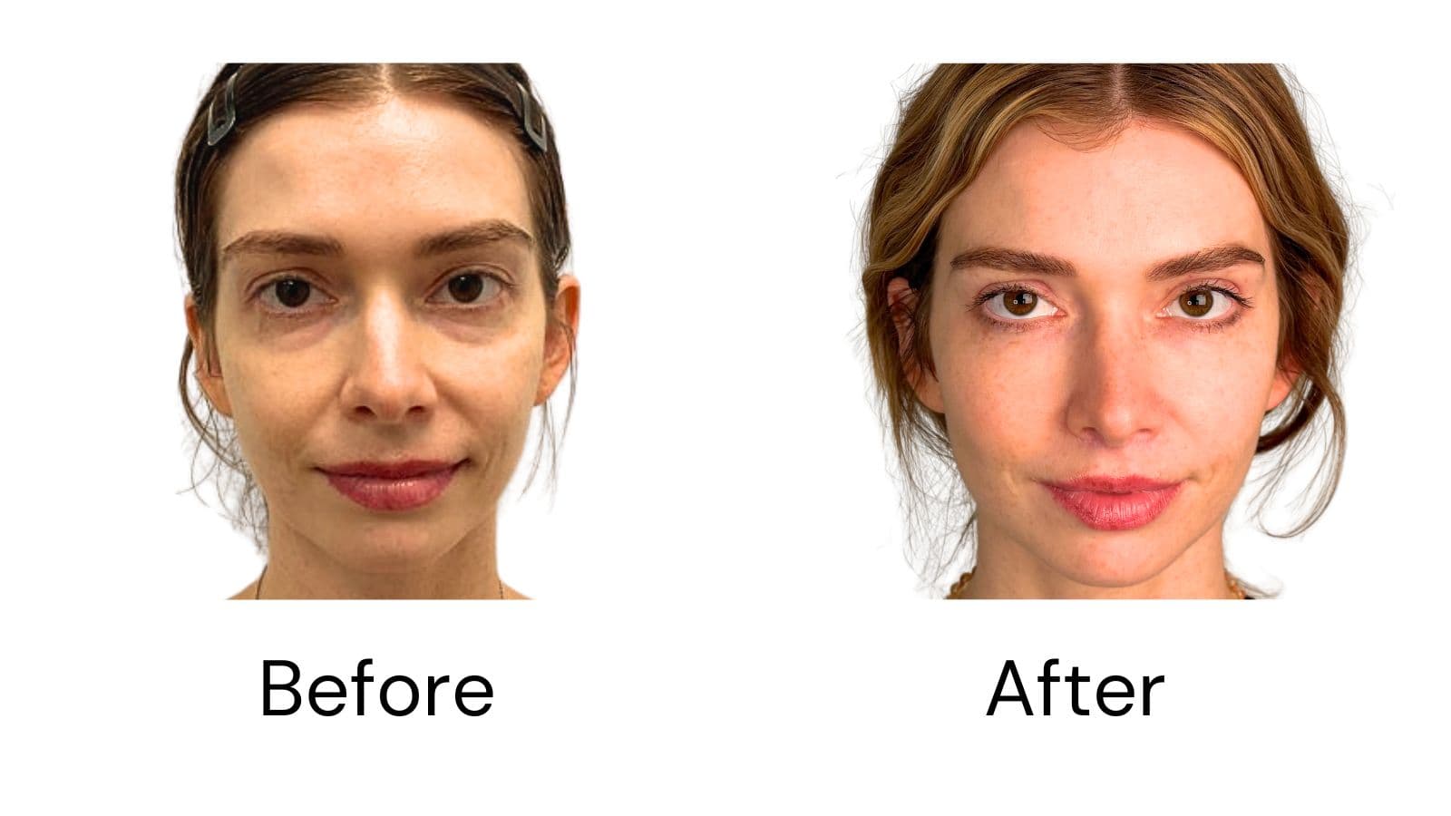 Facelift