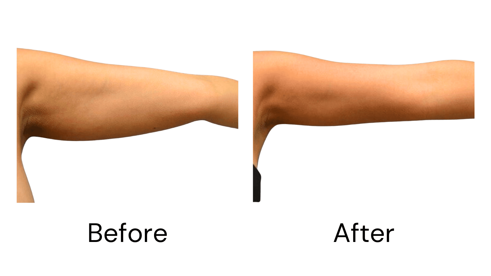 Liposuction