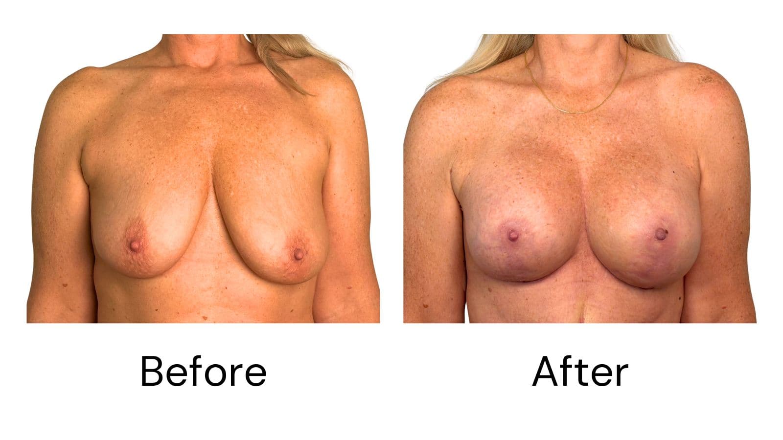 Breast Lift