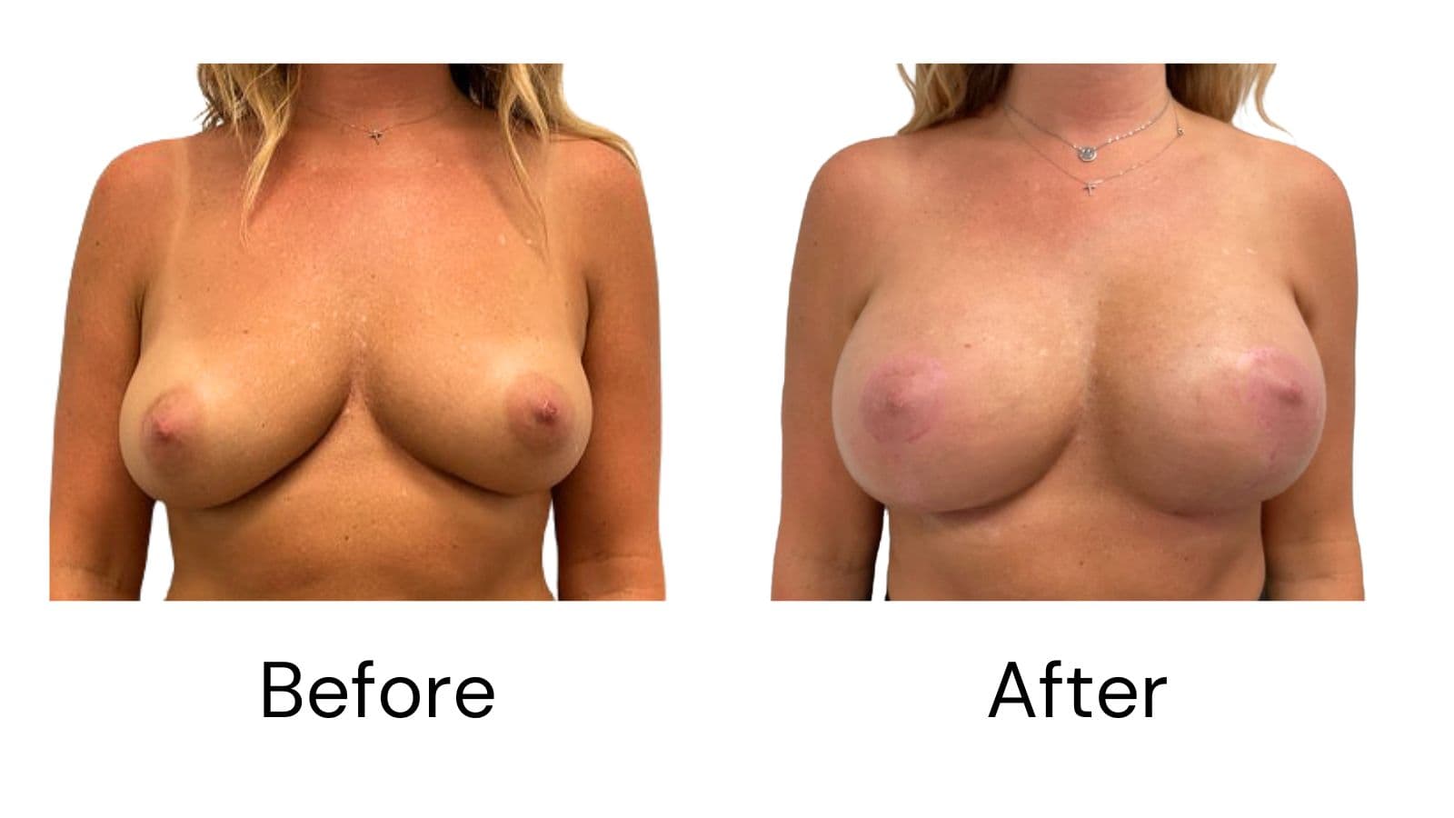 Breast Lift