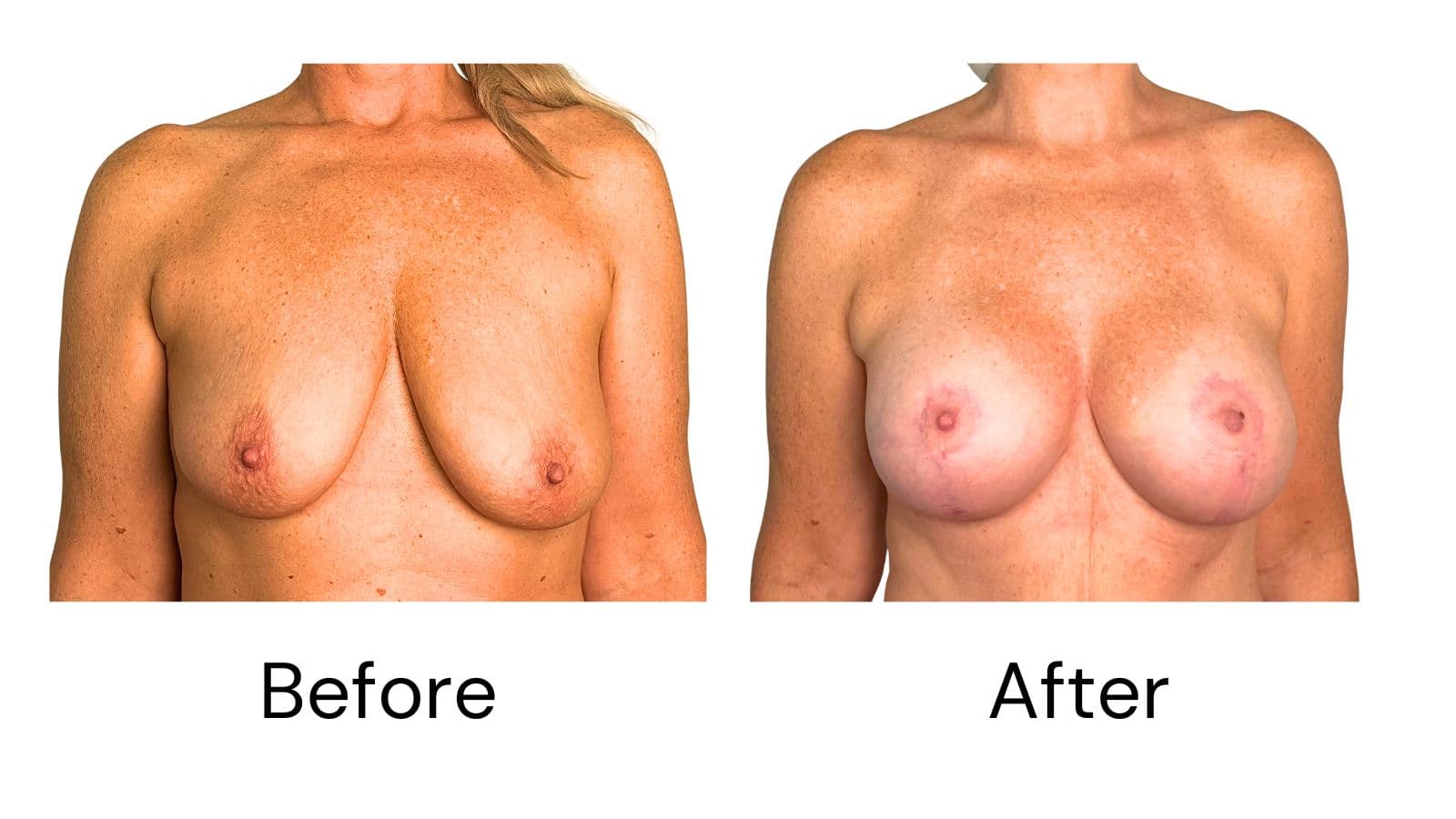 Breast Lift