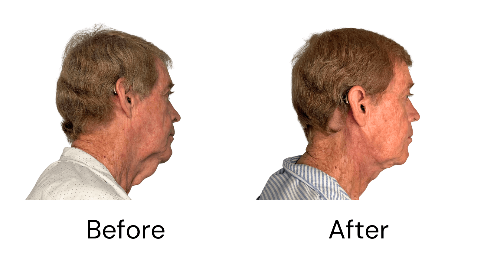 Neck Lift