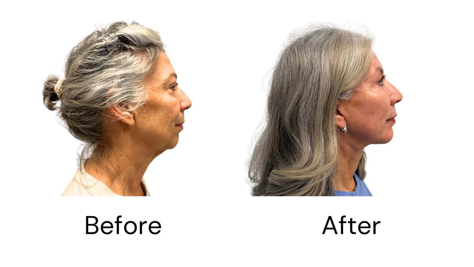 Neck Lift
