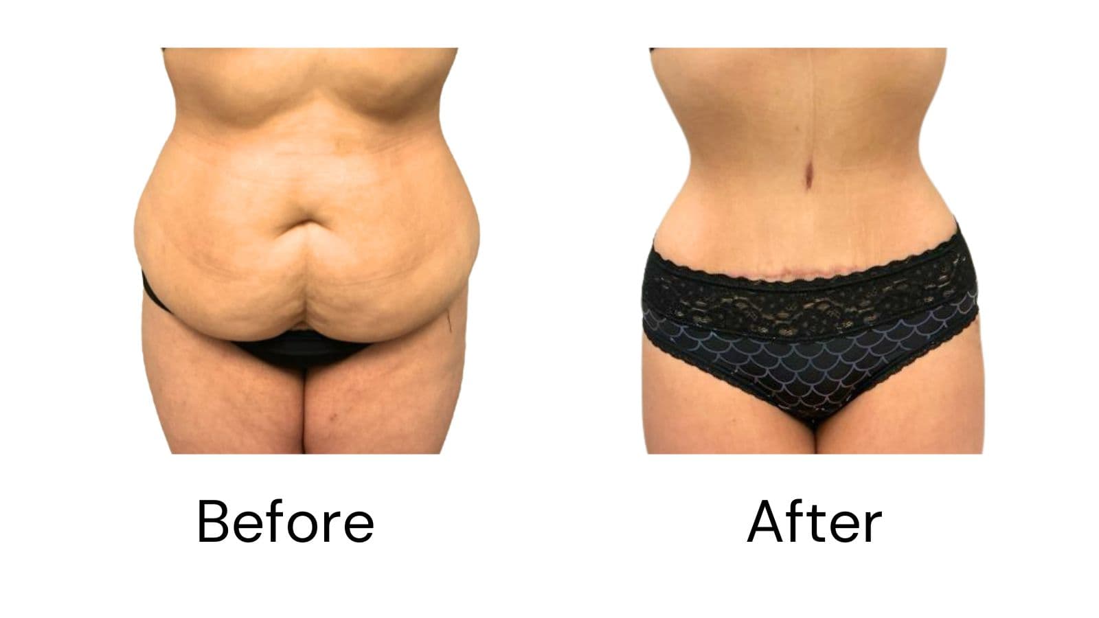 Tummy Tuck