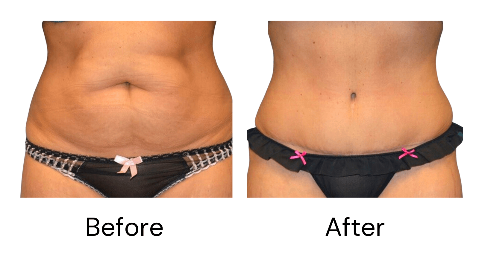 Tummy Tuck