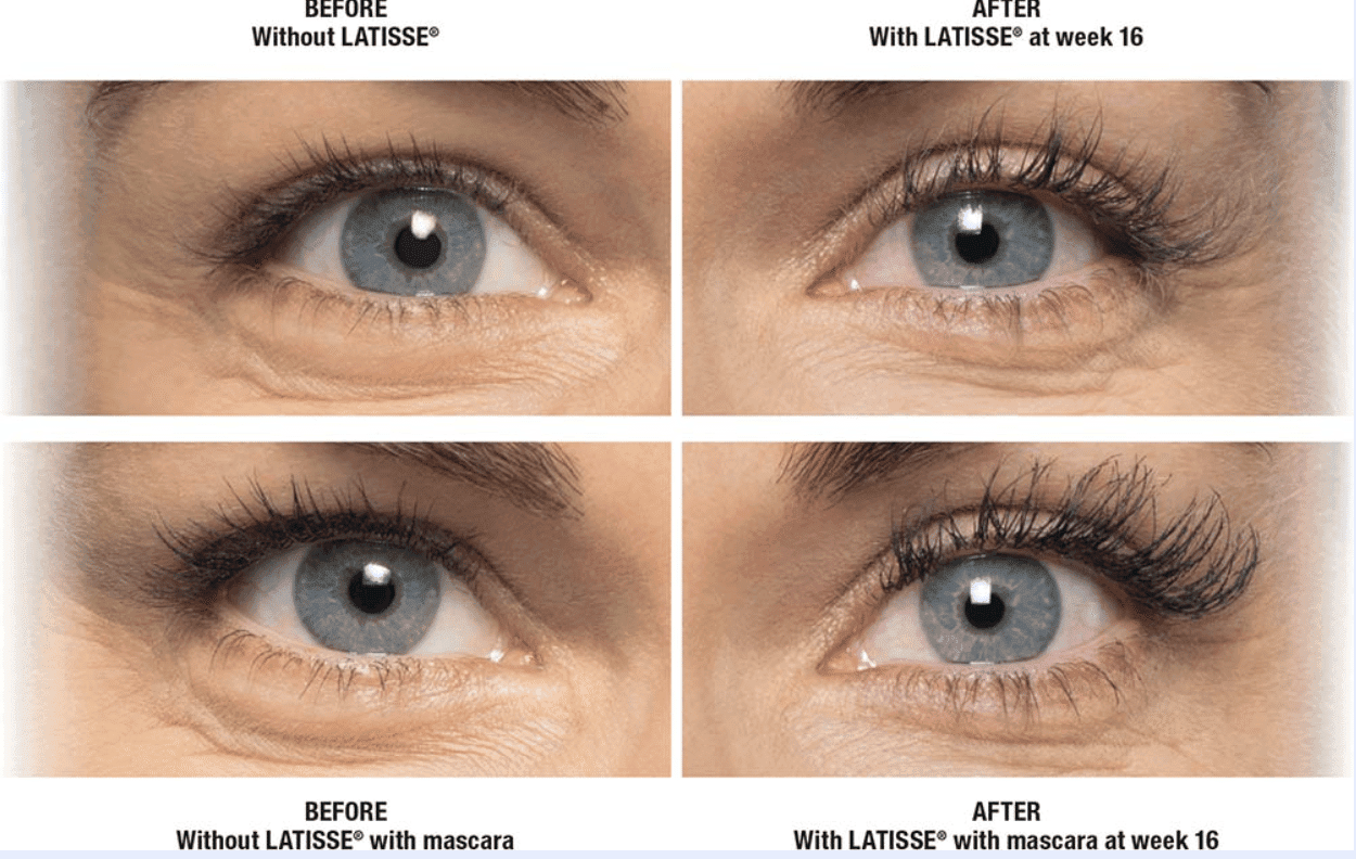 What is Latisse?