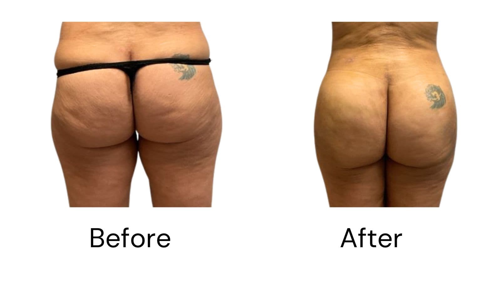 Advances in Brazilian Butt Lift Safety Reshape Patient Consultations, Says Dr. Raman Mehrzad